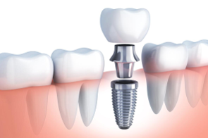 Implantes_dentales