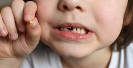 niño con caída de diente